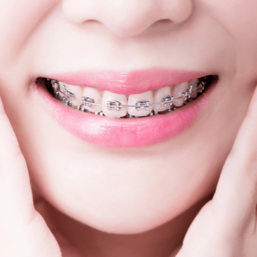 A woman with metallic braces smiling